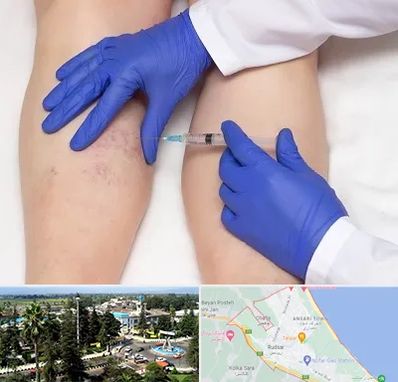 اسکلروتراپی در رودسر