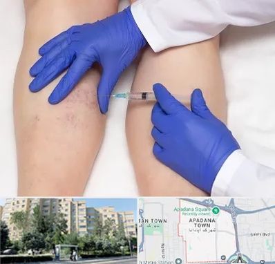 اسکلروتراپی در آپادانا