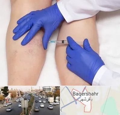 اسکلروتراپی در باقرشهر