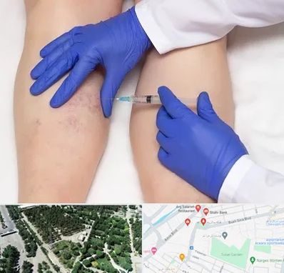 اسکلروتراپی در سالاریه قم