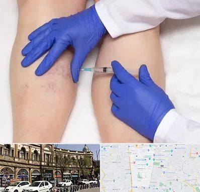 اسکلروتراپی در منطقه 11 تهران 