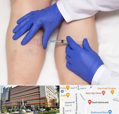 اسکلروتراپی در سهروردی 