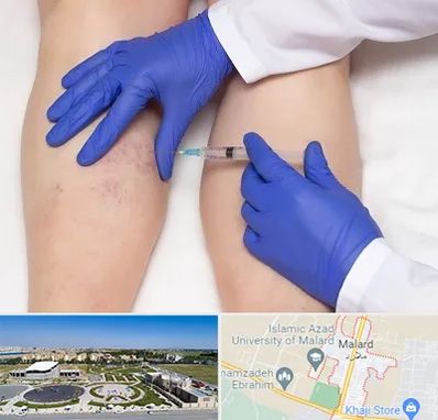 اسکلروتراپی در ملارد