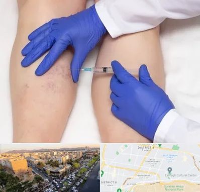 اسکلروتراپی در تهرانپارس 