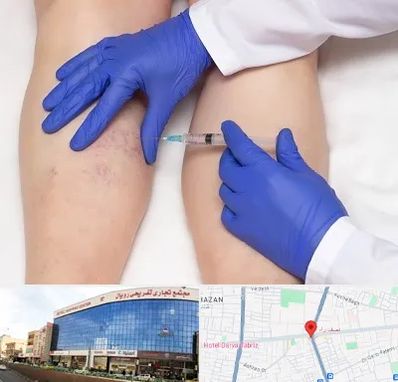 اسکلروتراپی در نصف راه تبریز