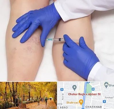 اسکلروتراپی در چهارباغ اصفهان