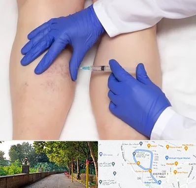 اسکلروتراپی در بلوار گیلان رشت