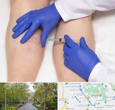 اسکلروتراپی در قدوسی غربی شیراز