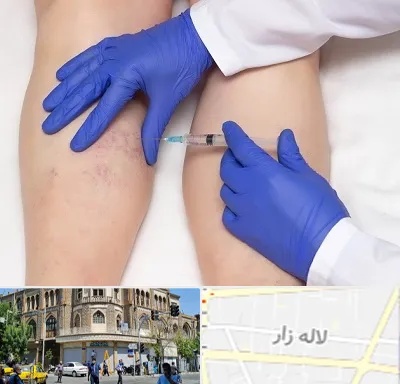 اسکلروتراپی در لاله زار