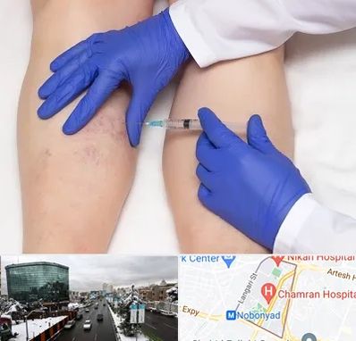 اسکلروتراپی در اقدسیه 