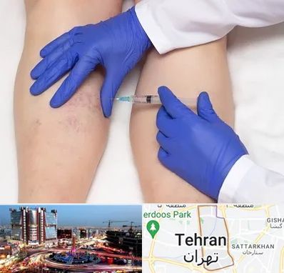 اسکلروتراپی در صادقیه 