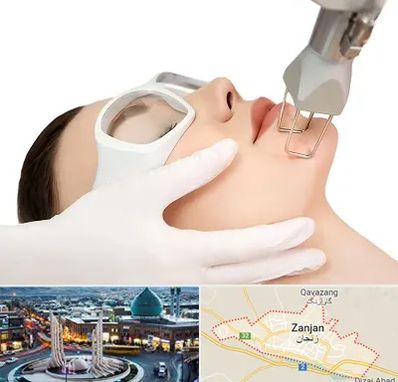 لیزر فرکشنال در زنجان