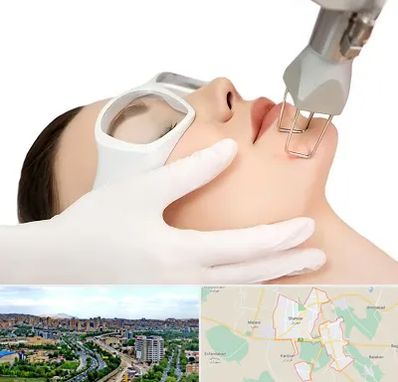 لیزر فرکشنال در شهریار