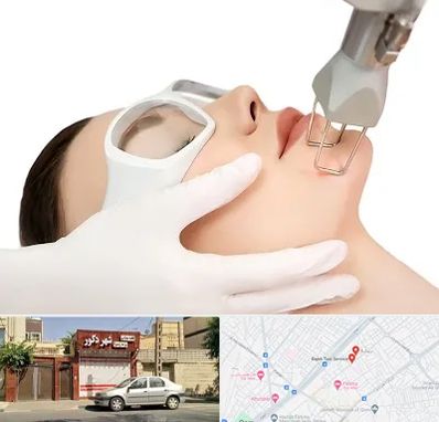 لیزر فرکشنال در باجک قم