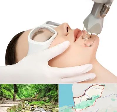 لیزر فرکشنال در گلستان