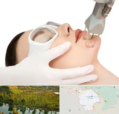 لیزر فرکشنال در بهبهان