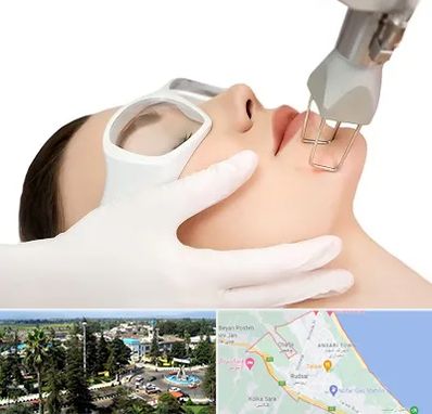 لیزر فرکشنال در رودسر