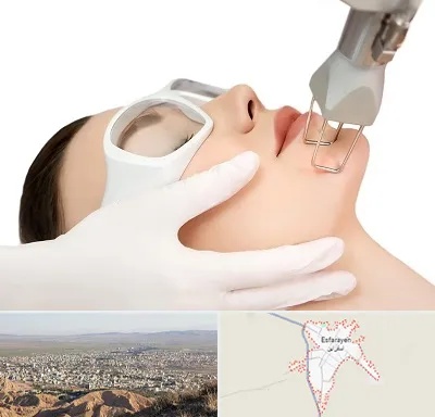 لیزر فرکشنال در اسفراین
