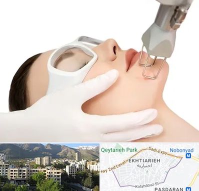 لیزر فرکشنال در اختیاریه 