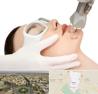 لیزر فرکشنال در قزوین