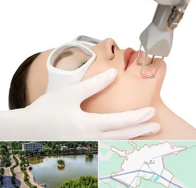 لیزر فرکشنال در لنگرود