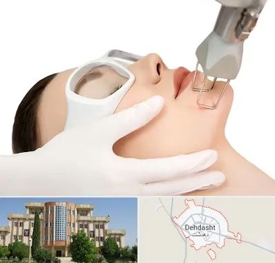 لیزر فرکشنال در دهدشت