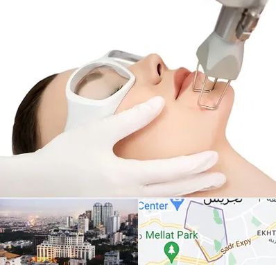 لیزر فرکشنال در الهیه 