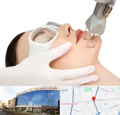 لیزر فرکشنال در نصف راه تبریز