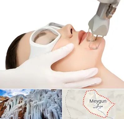 لیزر فرکشنال در میگون