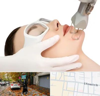 لیزر فرکشنال در خیابان فلسطین