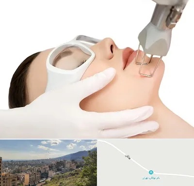 لیزر فرکشنال در بوکان تهران