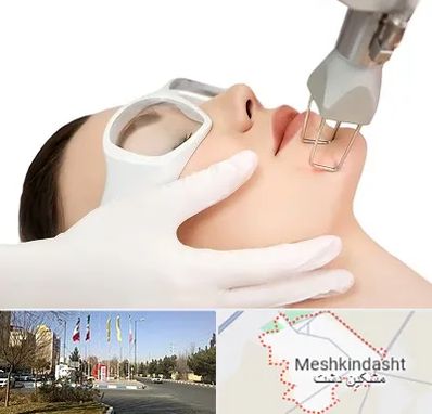 لیزر فرکشنال در مشکین دشت