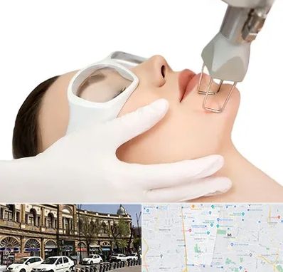 لیزر فرکشنال در منطقه 11 تهران 