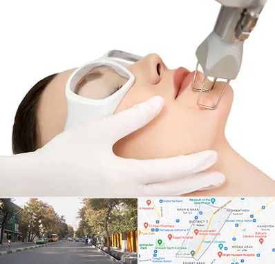 لیزر فرکشنال در شریعتی 