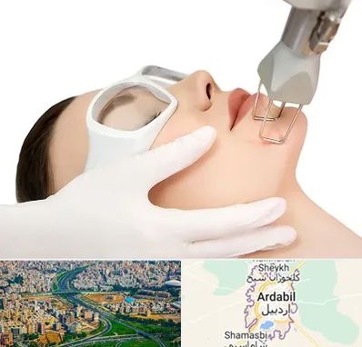 لیزر فرکشنال در اردبیل