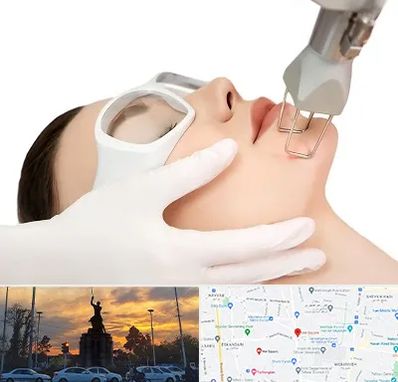 لیزر فرکشنال در میدان حر 