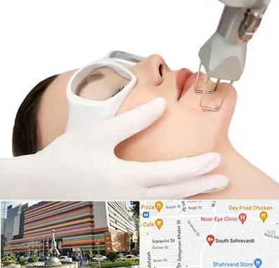 لیزر فرکشنال در سهروردی 