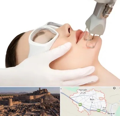 لیزر فرکشنال در بم