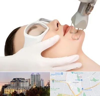 لیزر فرکشنال در فرشته 