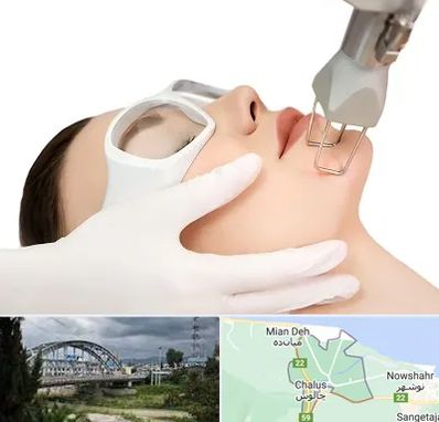لیزر فرکشنال در چالوس