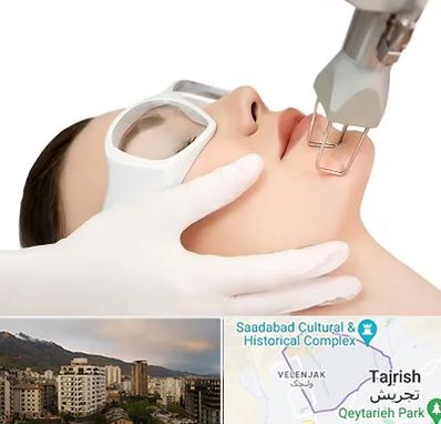 لیزر فرکشنال در زعفرانیه 