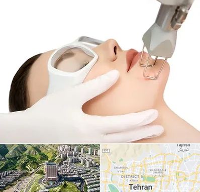 لیزر فرکشنال در شمال تهران 