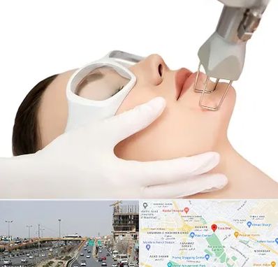 لیزر فرکشنال در بلوار توس مشهد 