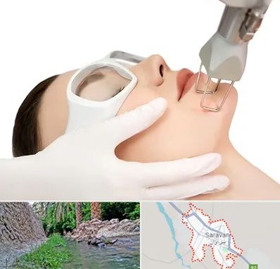 لیزر فرکشنال در سراوان