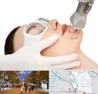 لیزر فرکشنال در ولیعصر ارومیه