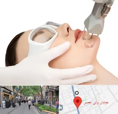 لیزر فرکشنال در ولیعصر شهریار