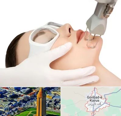 لیزر فرکشنال در گنبد کاووس