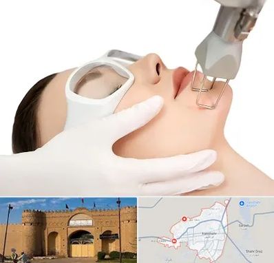 لیزر فرکشنال در ایرانشهر