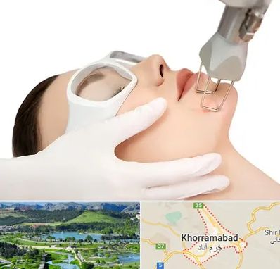 لیزر فرکشنال در خرم آباد