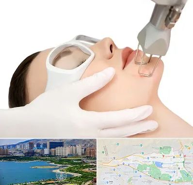 لیزر فرکشنال در منطقه 22 تهران 